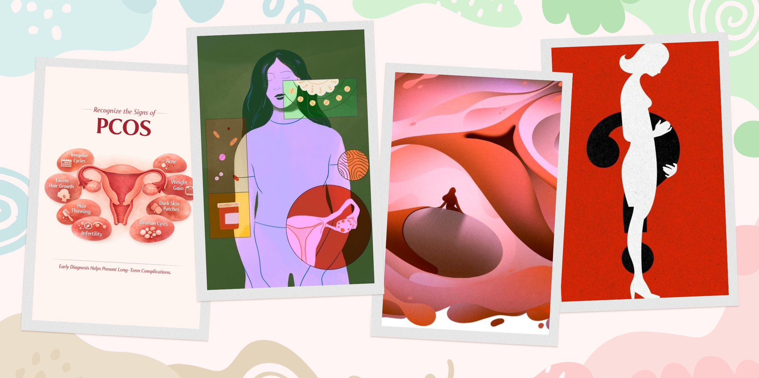 PCOS - Hội Chứng Buồng Trứng Đa Nang Là Gì?